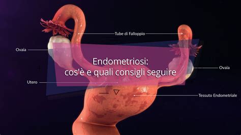 che cosa è l'endometriosi